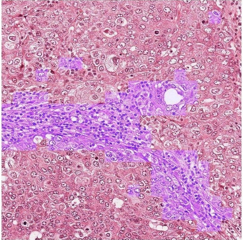 histo stroma segementation